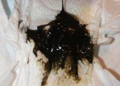 (新生兒正常大便) (新生兒正常大便)