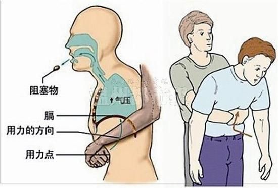 温州一幼儿园女童因桂圆卡喉窒息身亡