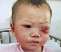 精神病爸戳瞎10个月女儿