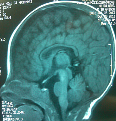  正常儿的MRI,有胼胝体
