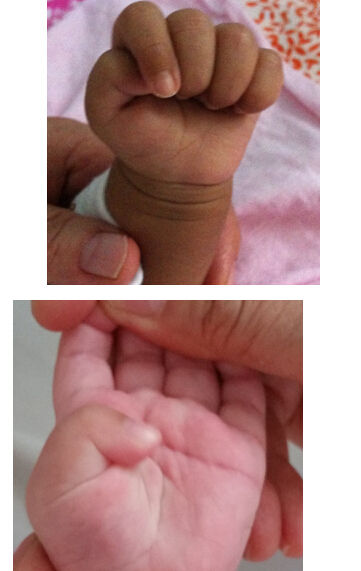 正常婴儿握拳时拇指屈曲