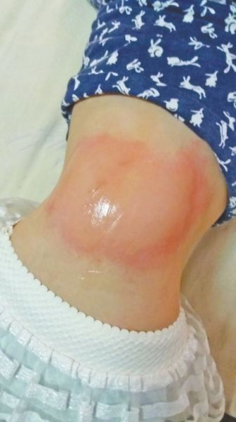 一名小学生背部皮肤过敏严重。