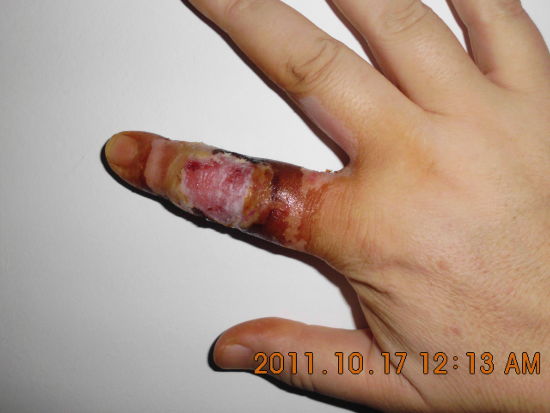 使用后溃烂的手指。图片央视提供