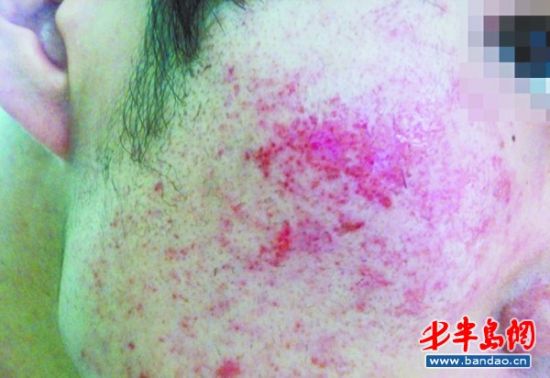 小冯面部严重过敏，布满了红疙瘩。
