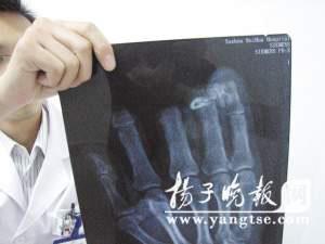 吴强左手被放大的X光片，最左边是大拇指，其余依次为断掉的四指，留下的阴影令人触目惊心。 谷岳飞 摄