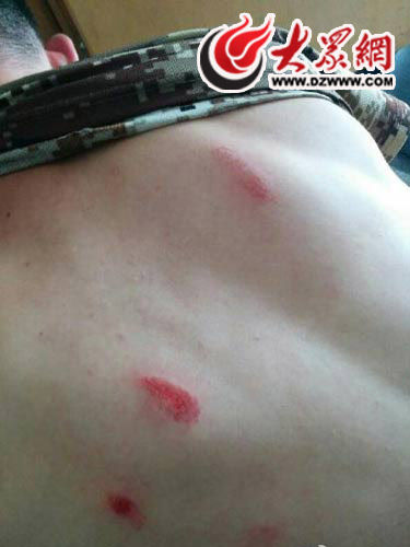 侯聚森的背部受伤。