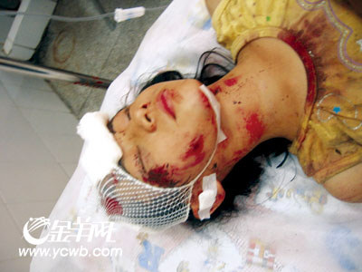 负重伤的12岁小女孩   (敏华/编制)