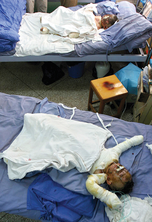 夫妻吵嘴点燃汽油 一家四口烧成"煳人"