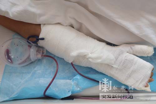 　伤者小蕾手部受伤严重。东北网记者 王忠岩 摄