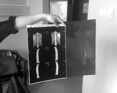      徐女士母亲展示女儿伤情。京华时报记者韩林君摄