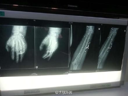 民警王伟双臂被打进40多粒铅弹
