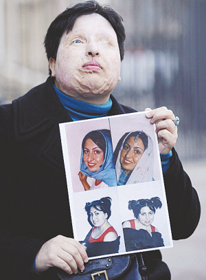 　　毁容后的阿梅内手拿以前的照片 