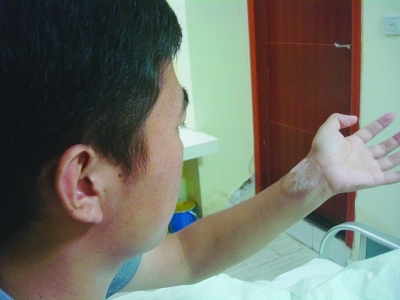 　　一位患者外敷“蓣根”导致皮肤起水泡后留下的疤痕。严悦 摄