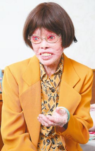 受柏杨帮助赴台治疗鱼鳞病 穿山甲人 感怀台湾 手机新浪网