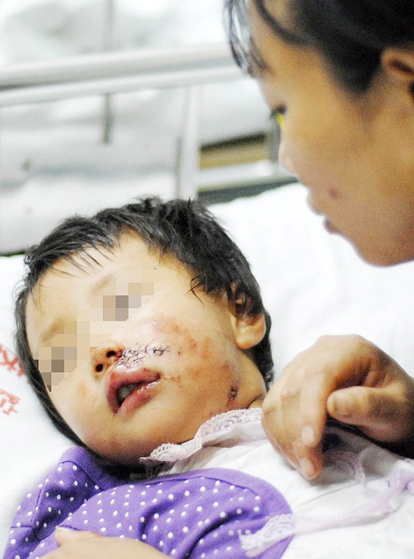 厦门何厝一女童遭恶狗撕咬几乎毁容