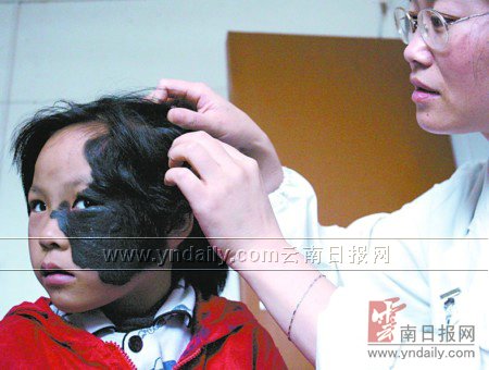 盖住左脸 无钱医治12岁小霞只能偷偷流泪再不植皮女孩可能要成黑面人