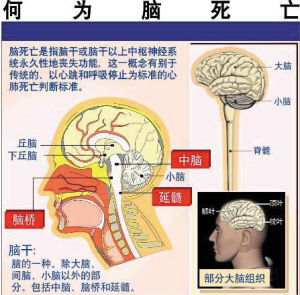 脑死亡判定标准