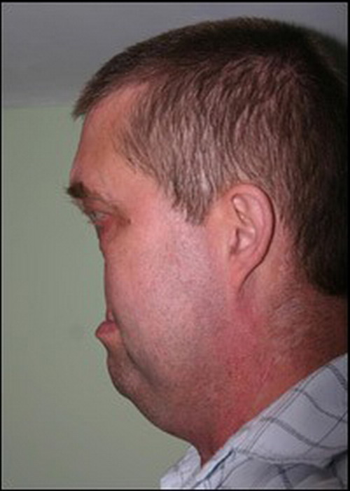 49岁男子彼得·加格2006年5月因患鼻腔癌被迫切除了整个鼻子和上唇