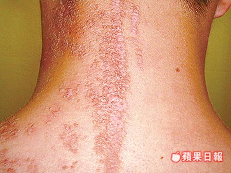 病"上皮痣变异种",左半边身体从头到脚都是咖啡色丘疹,遭嘲笑像"蟾蜍