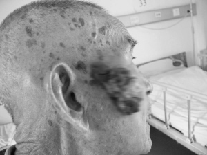 八旬娄伯脸颊长"菜花"