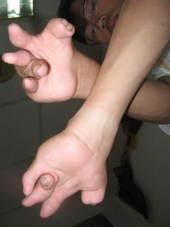 小伙双手畸形外观形似熊掌图