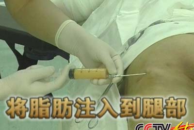 女子吸脂提臀失败 再抽肚皮补凹坑(图)