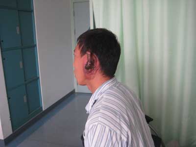 男子左耳长怪瘤13年难"抬头" 医生称通过手术可以治愈