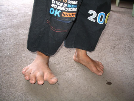 男孩得怪病六趾右脚比左脚大一倍