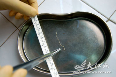 江西赣县一名男子阴囊长绦虫图