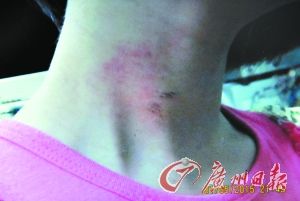 5月1日，小美脖子上的伤痕。(小美家属供图)