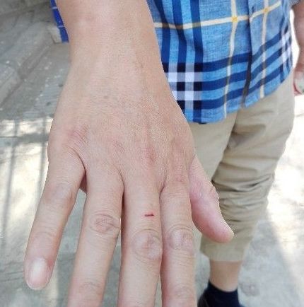 陈先生被同行殴打后，身上满是伤痕。