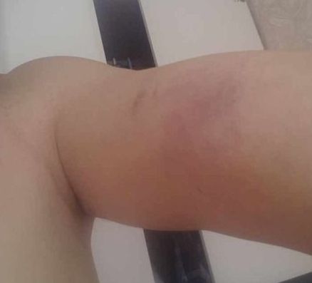 陈先生被同行殴打后，身上满是伤痕。