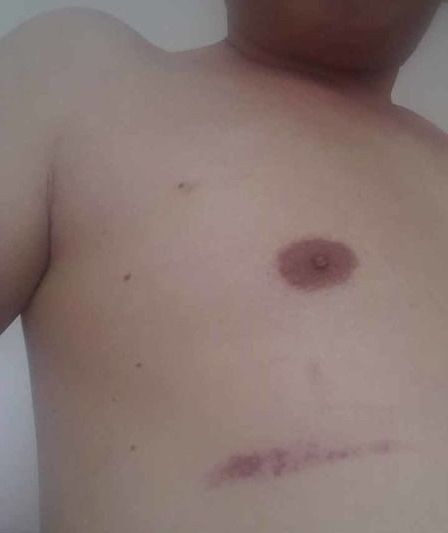 陈先生被同行殴打后，身上满是伤痕。