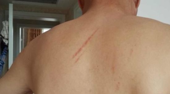 陈先生被同行殴打后，身上满是伤痕。