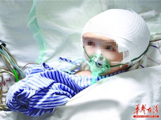 7月15日，涵涵在ICU病房接受康复治疗，她的头颅已经明显变小。记者 赵持 摄 