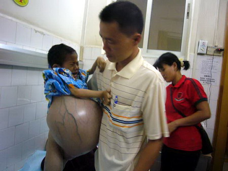 4岁女童患病腹部肿胀如鼓 网友呼吁救助(图)