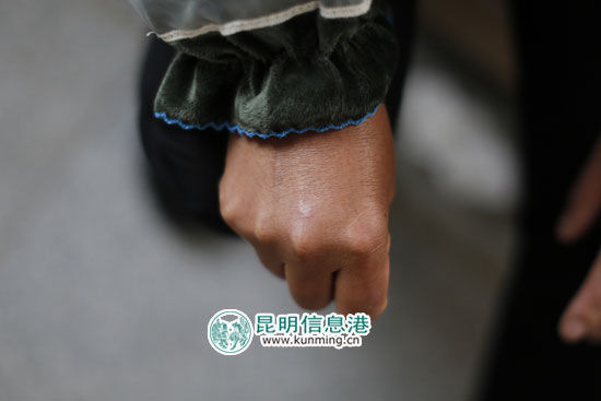 张秀的手臂被打伤