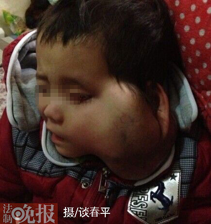 脸部的巨大肉瘤