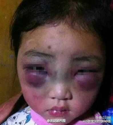 女童被打致几乎睁不开眼