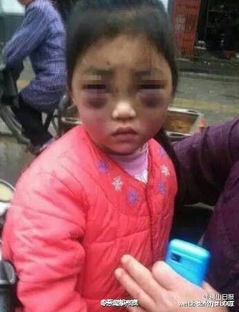 女童被打致几乎睁不开眼