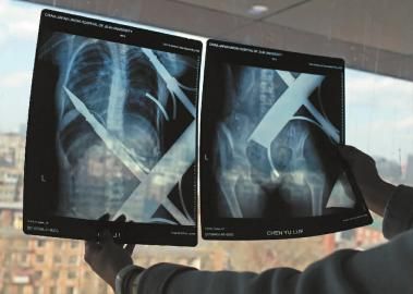 X光片显示一根钢筋将小女孩的右侧肩膀刺穿，另外一根则从后背腰部以上靠近脊椎的地方穿入 新文化记者 白石 摄 