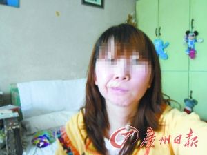 张雨在韩国的整容手术非常失败