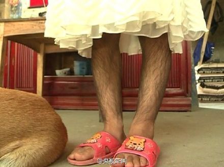 小玲从出生起全身就长满毛发，而且越长越密