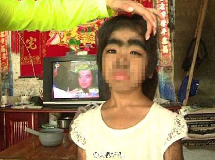 8岁桂林女孩小玲的梦想，是能大大方方地穿裙子。