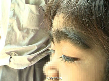 小玲的症状叫“返祖”，目前无药物可以治疗。