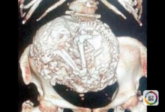 医生在X光照片里发现，她子宫里居然有一个“年逾60”的胎儿