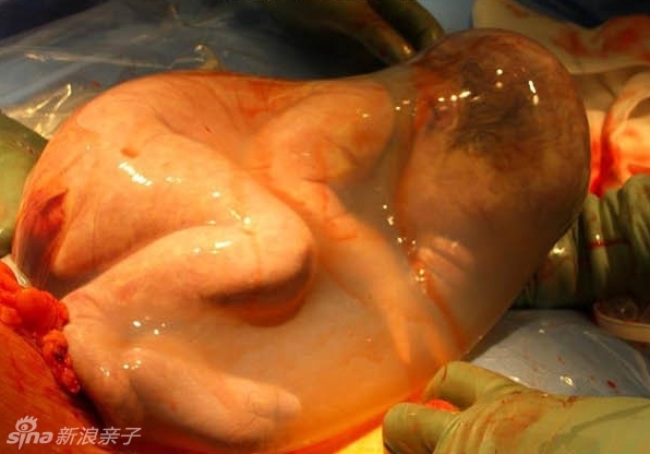 剖腹产宝宝出生震撼瞬间
