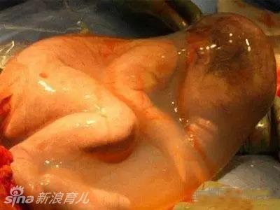 实拍宝宝从妈妈肚子里降临瞬间