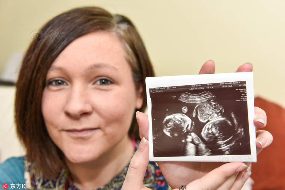 双胞胎共享羊膜囊 奇迹存活