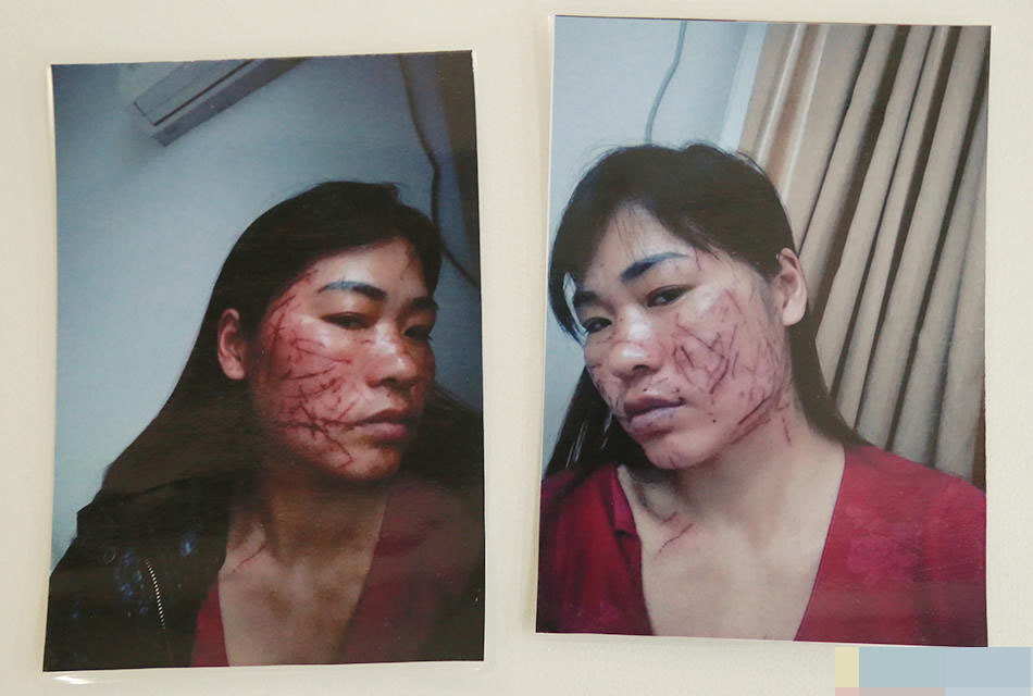 河南妈妈广州求医:脸被小三划了上百刀